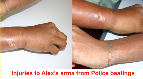 Injuries to Alex's arms from Police beatings