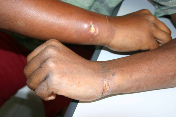 Bruises on Alex's arms caused by Police actions.