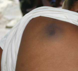 The bruise on the shoulder of Mrs Charlette after the assault by the State House security guard.