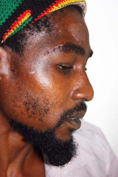 Mervin Samedi, 29 yr old farmer beaten by Police.